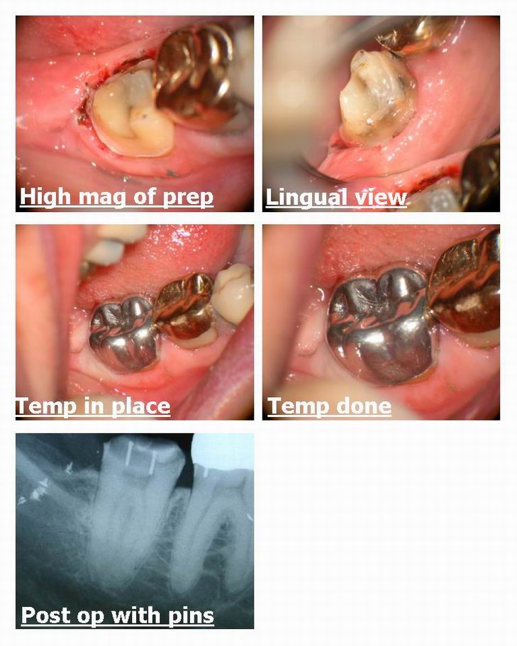 Resize of Fractured tooth osseous recontouring pg 3.jpg